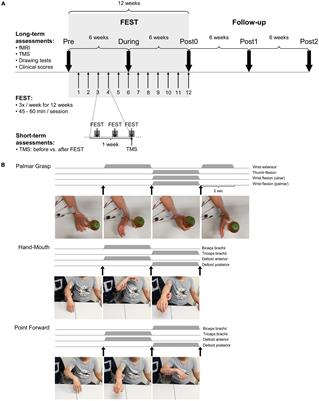 Cortical Re-organization After Traumatic Brain Injury Elicited Using Functional Electrical Stimulation Therapy: A Case Report